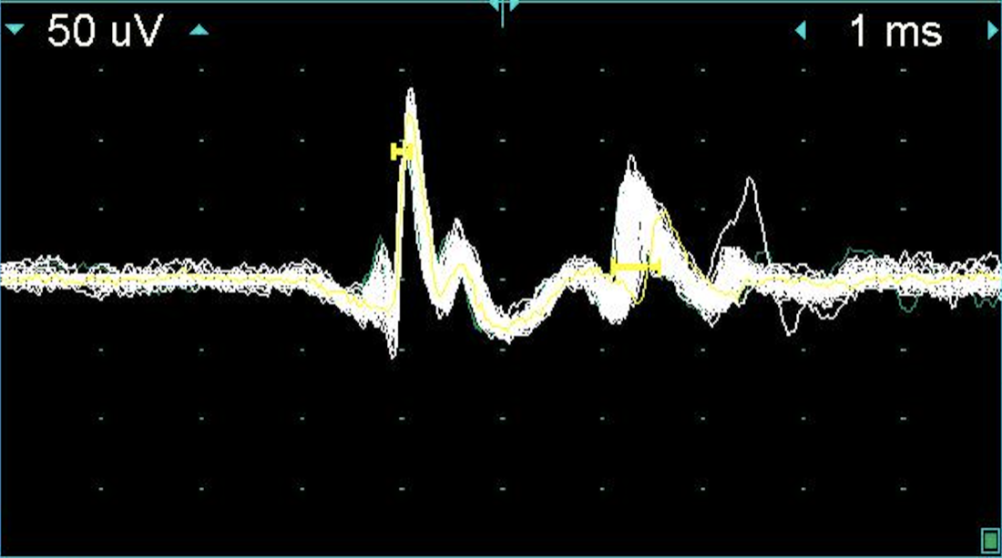 Single-fibre EMG waveform showing increased jitter